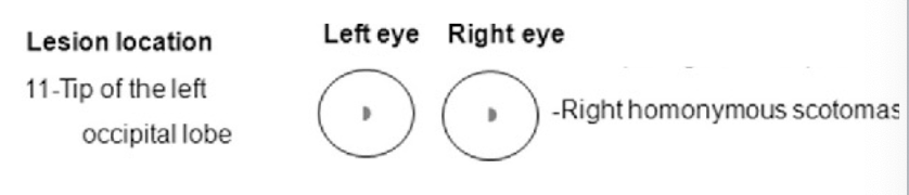 <p>occipital lobe optic radiations lesion </p><p>right homonymous scotomas </p>