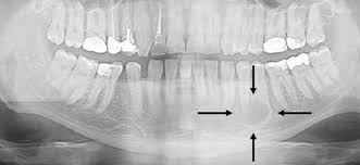 <p>An area of tissue that is damaged, diseased, or abnormal.</p>