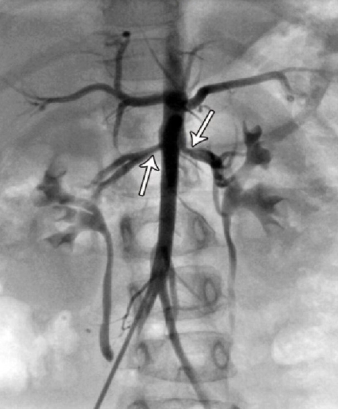<p>Gold standard</p><p>Catheter + dye to visualize arteries</p>