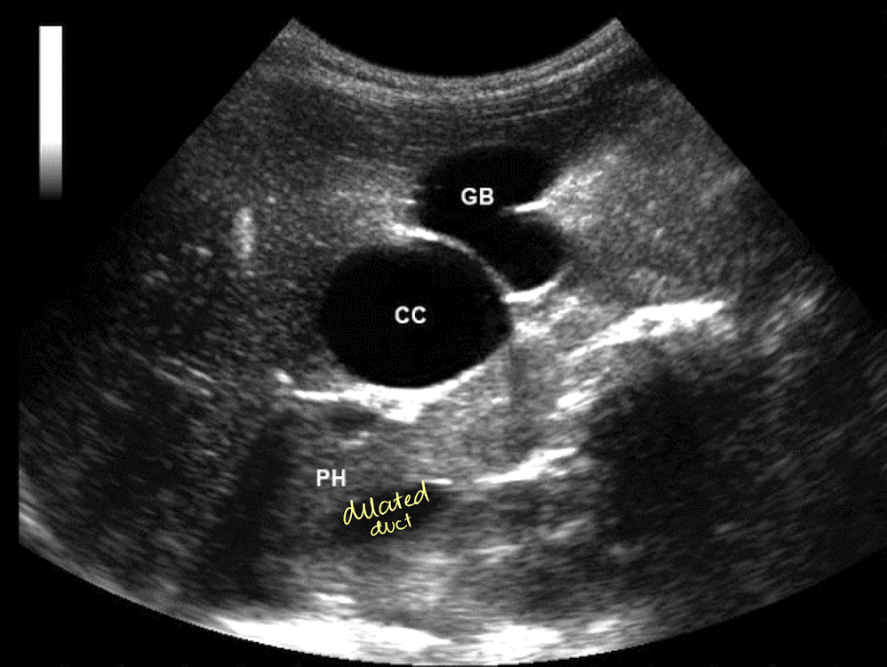 <ul><li><p>cystic <mark data-color="yellow" style="background-color: yellow; color: inherit;">dilation of biliary tree</mark></p></li><li><p>appear as <mark data-color="yellow" style="background-color: yellow; color: inherit;">true cysts</mark> in the RUQ</p></li></ul><p></p>