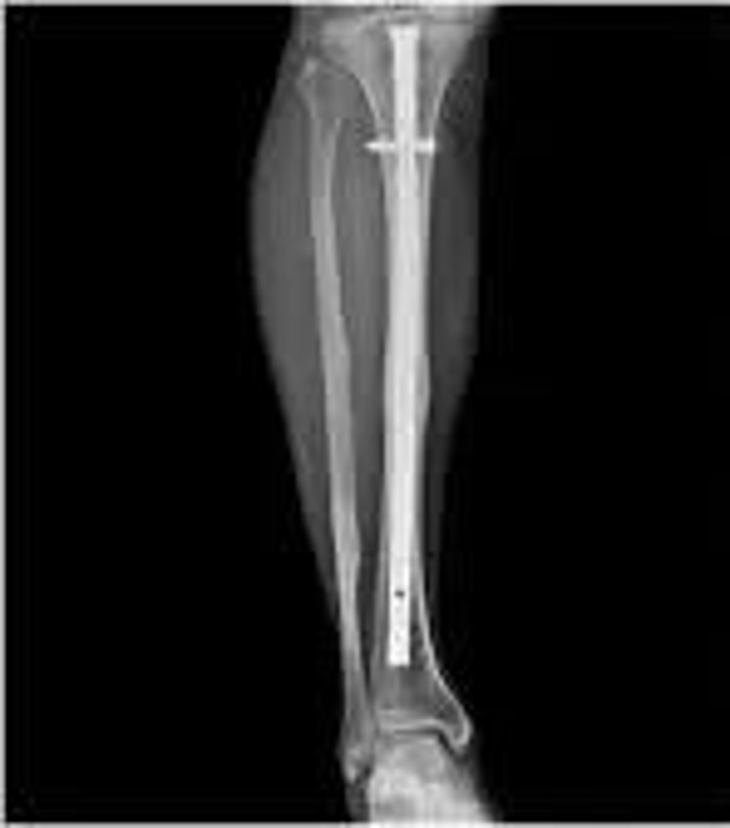 <p>bone marrow removed from medullary canal, common in broken long bones where medullary canal is easy to navigate</p>