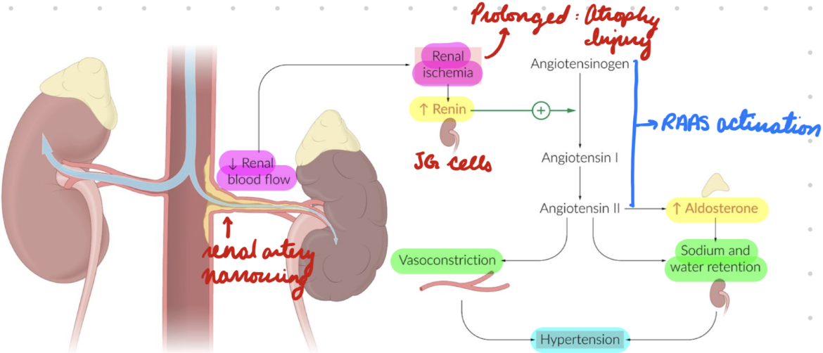 <ol><li><p>Cause dependent:</p></li></ol><ul><li><p><strong>Arterionephrosclerosis: </strong>Sustained high BP = Endothelial injury = Hyaline deposition in arterial walls</p></li><li><p><strong>Fibromuscular Dysplasia: </strong>Connective tissue and muscle tissue hyperplasia = Obstruct renal artery</p></li></ul><ol start="2"><li><p>Renal artery lumen narrowing = Decrease blood flow to kidneys = Ischemia</p></li></ol><ul><li><p>Prolonged ischemia = Renal injury + atrophy</p></li></ul><ol start="3"><li><p>Renal hypoperfusion = JG cells release renin = Activate RAAS = Increase aldosterone = Increase Na+ retention and vasoconstriction</p></li></ol><ul><li><p>JG hyperplasia</p></li></ul><ol start="4"><li><p>Secondary HTN</p></li></ol><p></p>