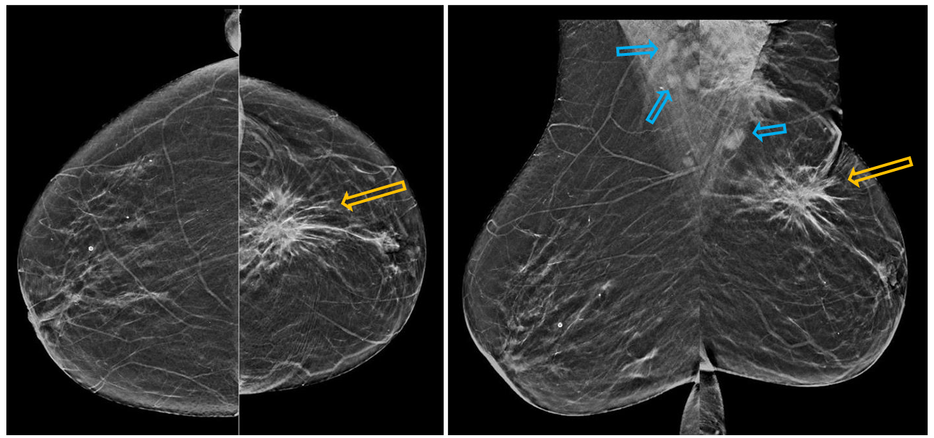 <p>Patient history: palpable mass in the left breast in a 41-year-old female patient</p><p>Modality: mammograms of the right and left breast, low-energy beam technique (30 kV)</p><p> Region: left and right breasts, craniocaudal (CC, left images) and mediolateral oblique (MLO, right images) views </p><p>Radiologic sign: spiculated asymmetric lesion of the left breast (upper quadrants, on the border of medial and lateral quadrants). It is easier to detect lesions in adipose (fatty) breast than in dense breast. Axillary metastatic lymph nodes in the projection of the pectoral muscle (blue arrows). </p><p>Diagnosis: invasive carcinoma of the left breast, normal right breast</p>