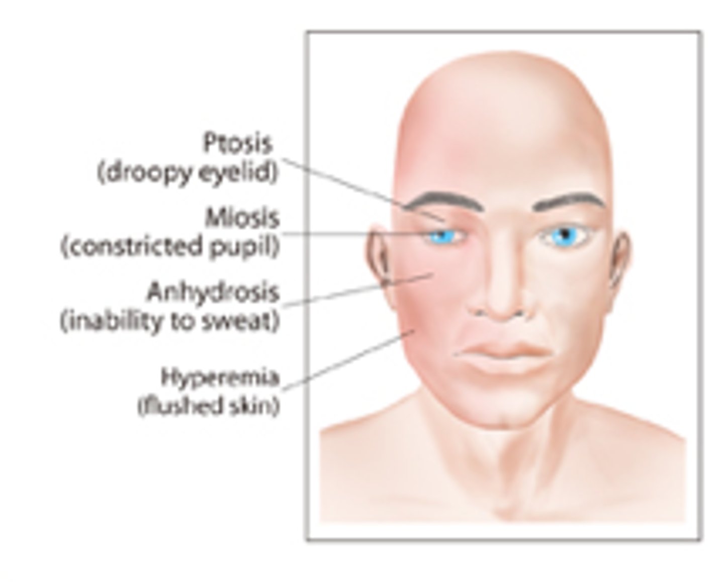 <p>1. Ptosis (upper eyelid droop)</p><p>2. Miosis (constricted pupil)</p><p>3. Anihidrosis (decreaed sweating)</p>