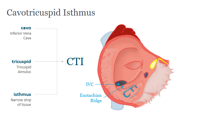 <p>Cavotricuspid Isthmus - narrow strip of tissue</p><p>Characteristic: pathway of slow conduction, likely due to anisotropic muscles</p><p>Boundaries: IVC/Eustachian ride and annulus of the tricuspid valve</p>