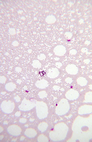 mansonella perstans microfilariae