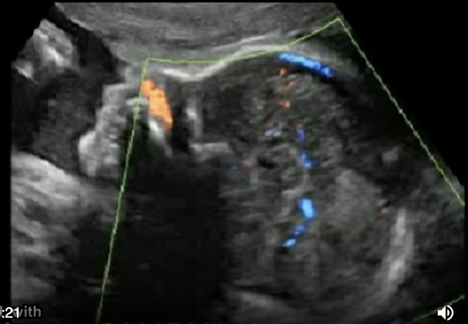 <p>the color doppler portion shows </p><p>a) no pericallosal artery</p><p>b) thrombus of vein of galen</p><p>c) normal fetal anatomy</p><p>d) no circle of willis </p>