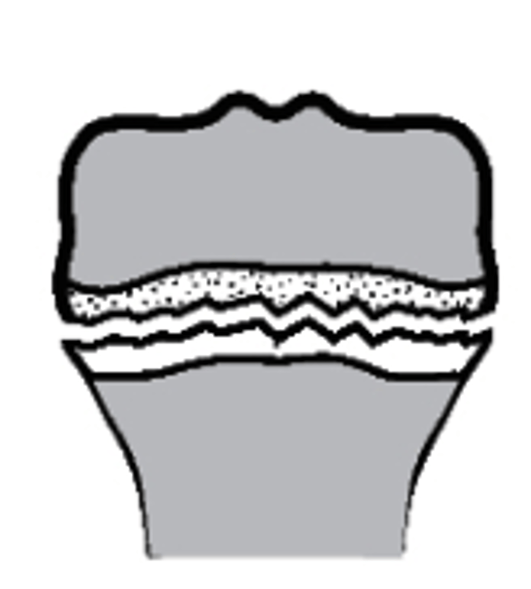 <p>what type of Salter-Harris fracture is this?</p><p>a. Type I</p><p>b. Type III</p><p>c. Type IV</p><p>d. Type II</p>