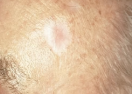 <p>A scar-like appearing form of basal cell carcinoma (BCC)</p>