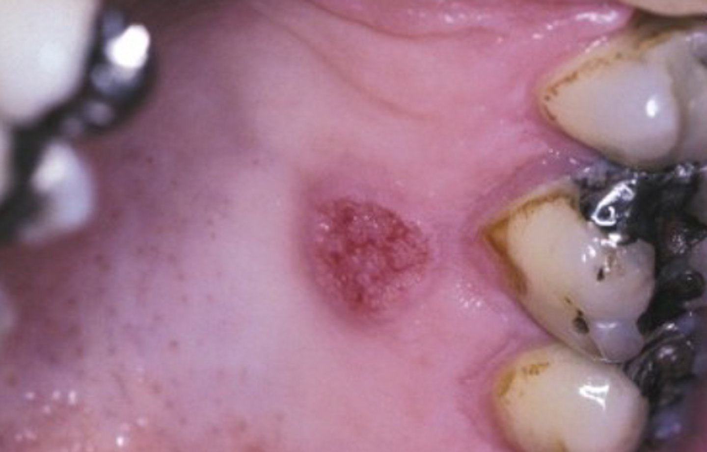 <p>treatment for which benign epithelial lesion:</p><p>• Excision is the treatment of choice</p><p>• Tend not to recur even if incompletely excised</p>