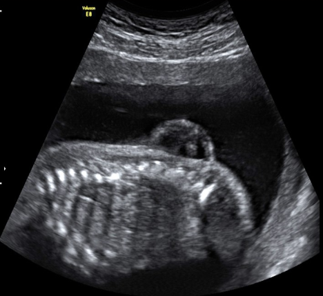 <p>a myelomeningocele refers to </p><p>a) herniation of neural tissue through cranial opening</p><p>b) herniation of meninges through cranial opening</p><p>c) herniation of meninges + neural tissue through vertebral opening</p><p>d) herniation of meninges through vertebral opening</p>