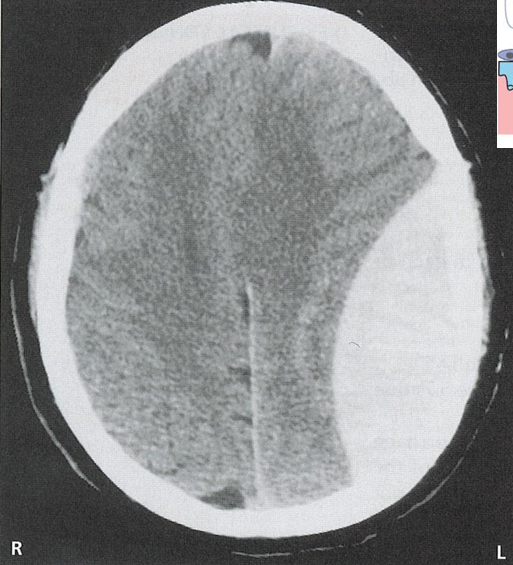 <p>The tearing of the middle meningeal _____ which can occur due to head traumas leads to bleeding in extradural space or _____ ____________ , this happens very fast and causes a coma hours after incident , ____ shaped </p>