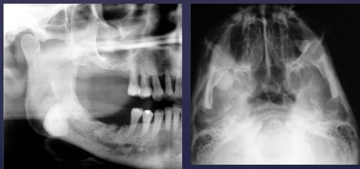 <p>• Well defined radiopaque mass</p><p>• Internal structure- uniformly radiopaque or internal trabecular structure</p><p>• Maybe be exophytic, extending into adjacent soft tissue</p>