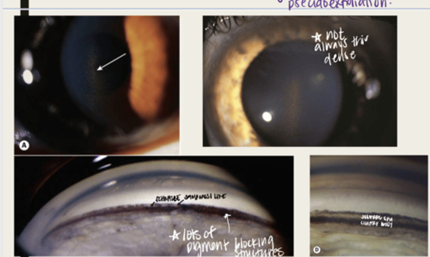 <p>release of pigment granules from the iris pigment epithelium</p>