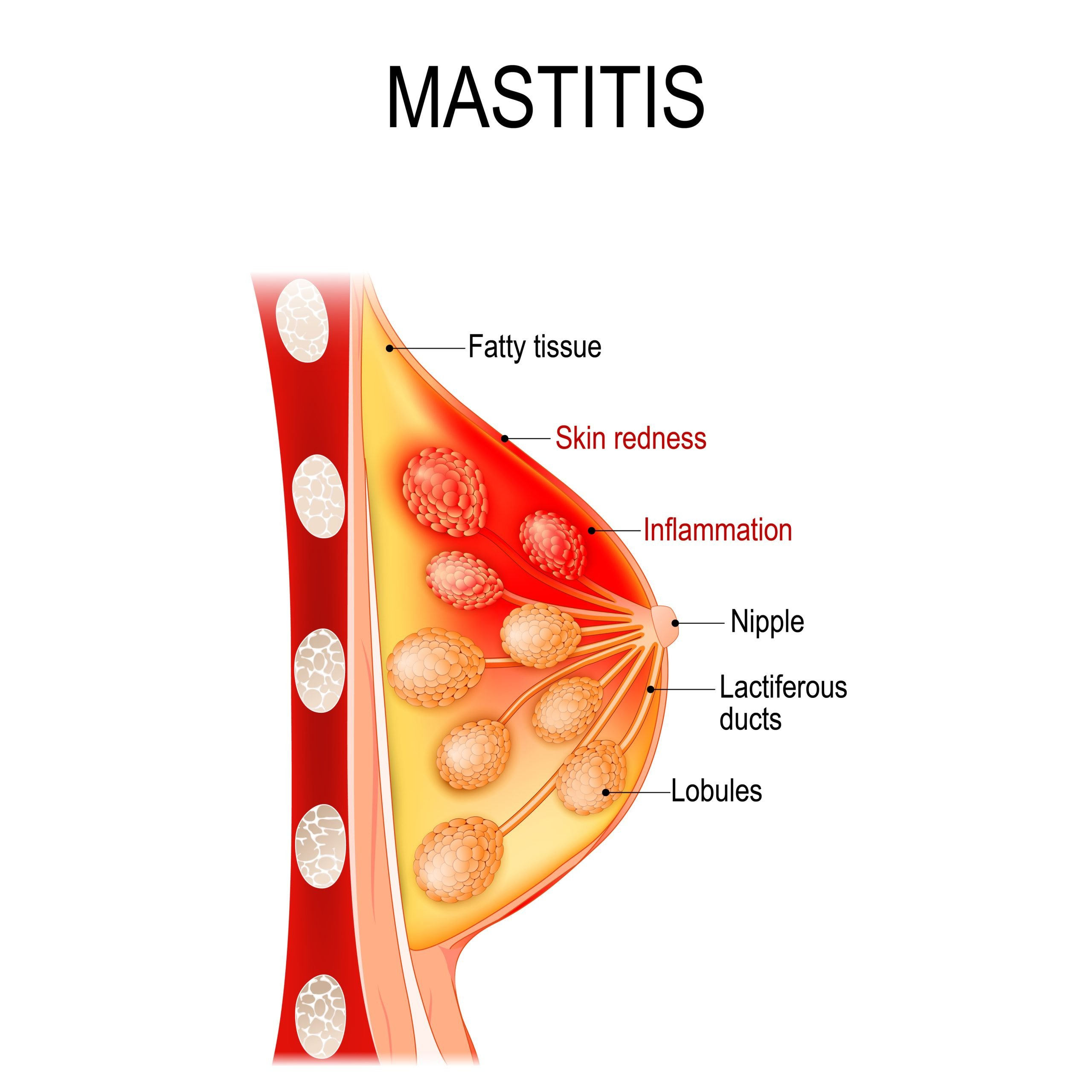<p>infection of the breast involving the nterlobular connective tissue and is usally unilateral </p>