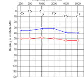 <p>What patient is this? what kind of hearing loss do they have?</p>