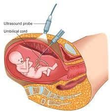 <p>→ Performed by inserting a thin needle through the mother’s abdomen into the umbilical vein, guided by ultrasound.</p><p>→ It allows direct access to fetal circulation, making it one of the most precise methods for evaluating fetal health.</p>