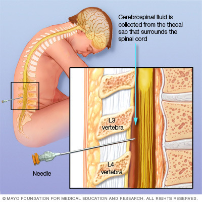 lumbar puncture, CT, EEg ---> CSF (gram stain or culture)