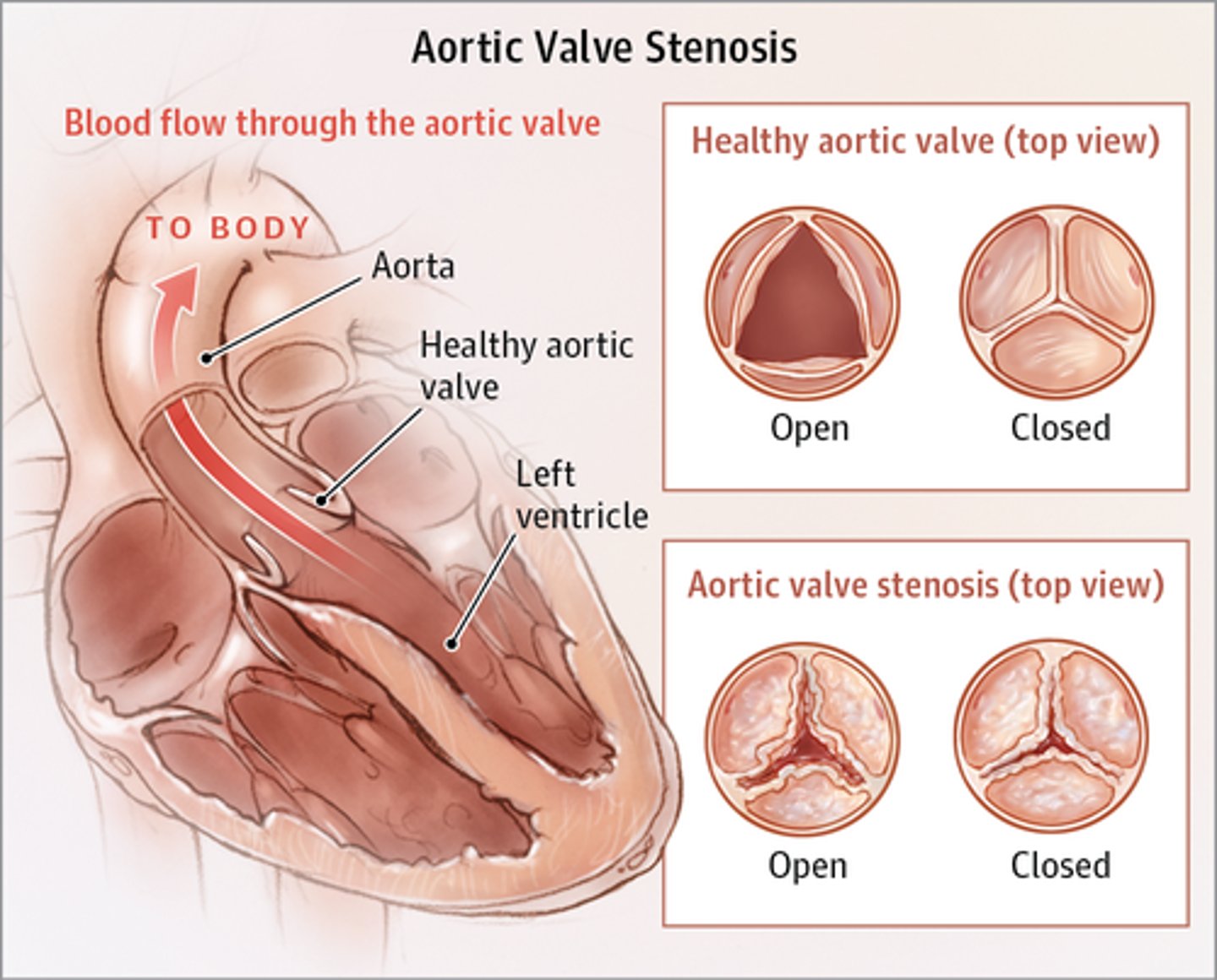<p>- Often congenital</p><p>- Obstruction of blood flow from left ventricle to aorta leads to ventricular hypertrophy, decreased CO, pulmonary hypertension, and HF</p><p>- S/S: angina, syncope, dyspnea (symptoms do not present until valve is 1/3 original size), diminished S2, prominent S4</p><p>- Require valve replacement</p><p>- Use nitro cautiously because it can reduce preload &amp; BP, can worsen chest pain</p>