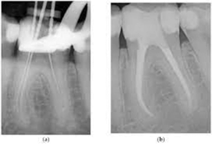 <p>image on left is files cleaning out the pulp canal and the right image is the final X-ray after completion of placing gutta percha and the temp restoration</p>