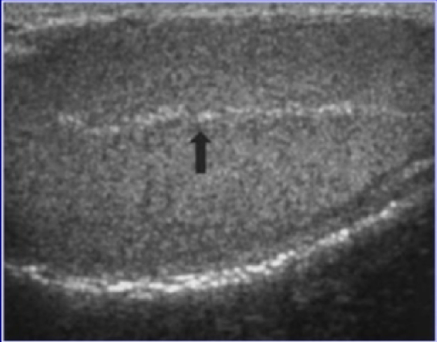 <p>connective tissue in the center of testis</p><p>visible on U/S, can be a landmark when searching for a retained testicle in abdomen</p>