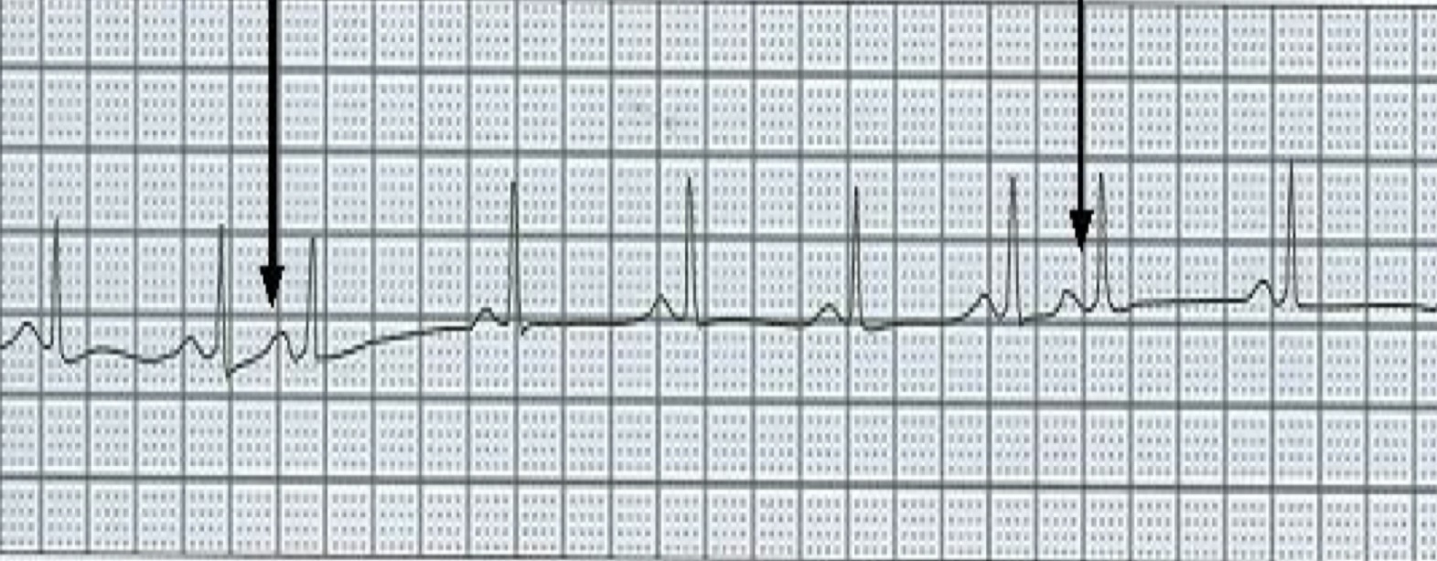 <p>Premature atrial contractions (PACs) </p>