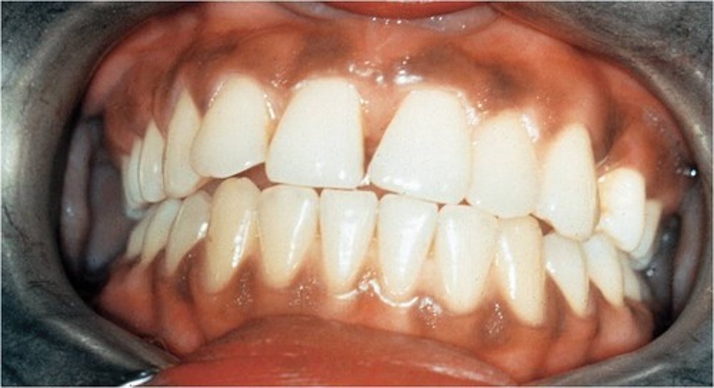 <p>-The pigment that gives color to skin, eyes, hair, mucosa, and gingiva</p><p>-Most commonly observed in dark-skinned individuals</p>