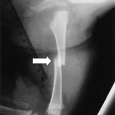 Traverse Fracture