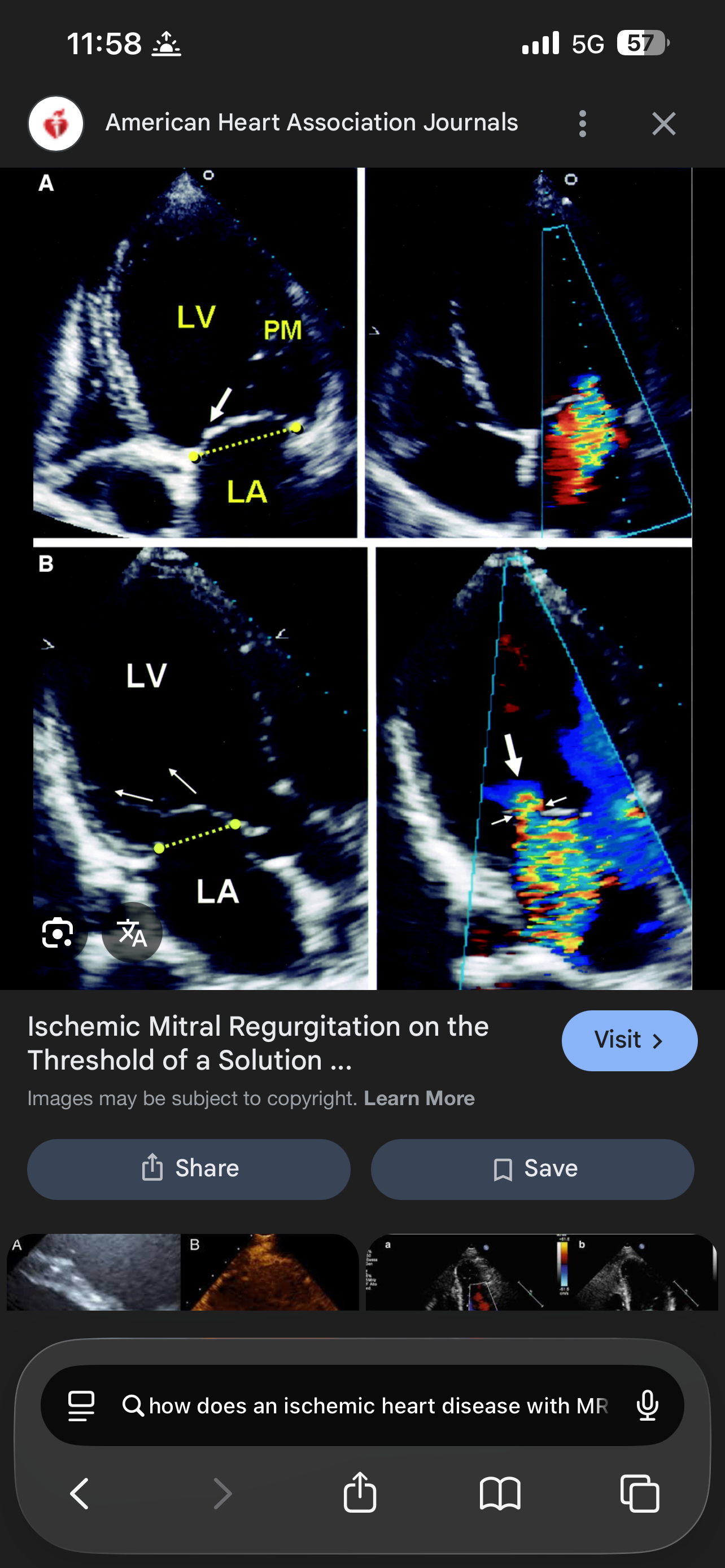 <p>What is Ischemic MR is caused by</p>