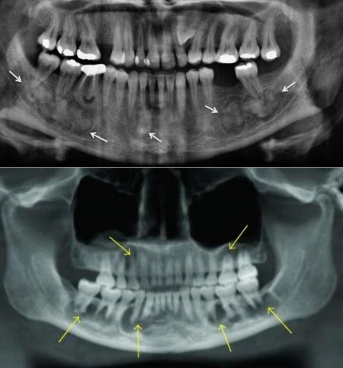 <ul><li><p>Multiple focal involvement not limited to the anterior mandible</p></li><li><p>Patients may just have lesions in the posterior jaws but many patients have lesions throughout</p></li></ul><p></p>