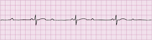 Rate: atrial 60 – 100; ventricular — half the atrial rate

Regularity: regular

P waves: upright, matching, 2 per QRS

PR: constant on the conducted beats

Qrs: < 0.12 secs