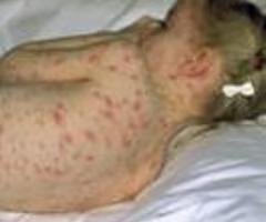 <p style="text-align: left;">macules <strong>start in center of trunk</strong> and moves to <strong>face and proximal extremities</strong></p><p style="text-align: left;">progress from macules, to papules, to vesicles, to crust formations</p><p style="text-align: left;">scabs appear in about 1 week</p>