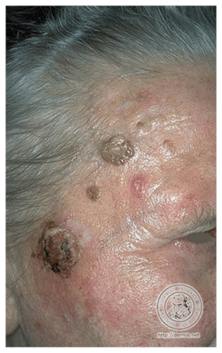 <p>seborrheic keratosis</p>
