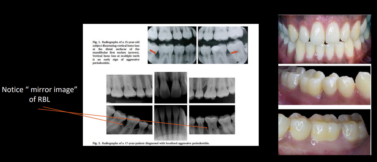 <ul><li><p>Genetic</p></li><li><p>Due to P. gingivalis and A.A bacteria</p></li><li><p>3:1 female to male ratio</p></li><li><p>30 years or younger patient</p></li><li><p>Usually stage 3 grade C, rapid sudden disease and gross deposits of calculus are uncommon</p></li><li><p>Mirror images of RBL</p></li><li><p>Refer to PG Perio for amoxicillin + metronidazole adjunct treatment to SRP</p></li></ul><p></p>