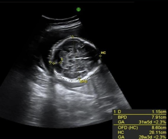 <p>what cranial abn is usually a <strong>normal variant </strong>but has been assoc w/<strong>trisomy 21 + spina bifida</strong></p><p>.</p><p>a) encephalocele</p><p>b) exencephaly</p><p>c) dolichocephaly</p><p>d) brachycephaly</p>