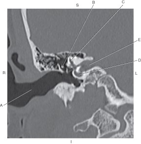 <p>Which line points to the external auditory meatus (EAM)?</p>