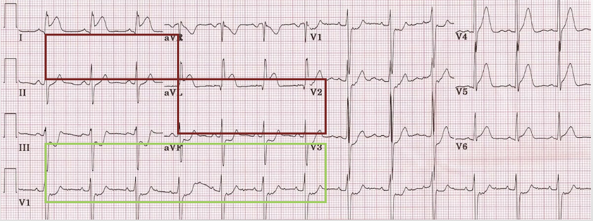 <p>ST elevations in 2+ lateral leads (I, aVL, V5, V6) + reciprocal changes in the inferior leads (II, III, aVF)</p>