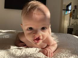 <p>afwijking (spleet)aan lip, kaak en of gehemelte die meestal doorloopt tot in de neus</p>