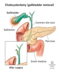 <p>cắt túi mật (chole - galbladder)</p>