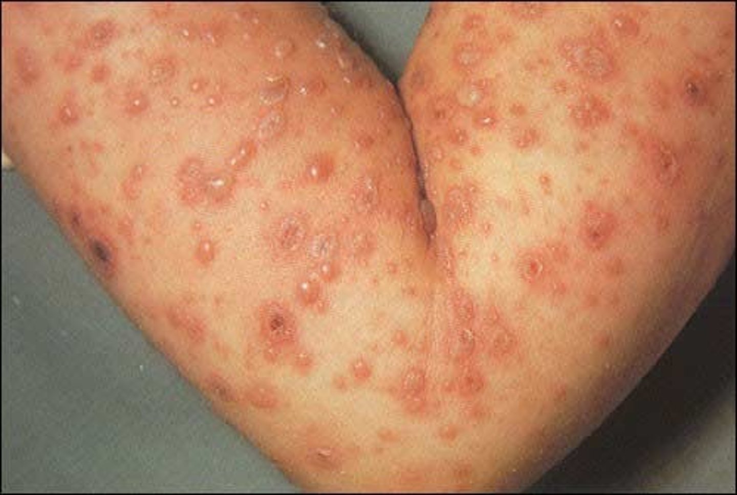 <p>illness caused by the varicella-zoster virus</p><p>It brings on an itchy rash with small, fluid-filled blisters</p>