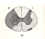 <p>a lesion here would result in what clinical presentation?</p>