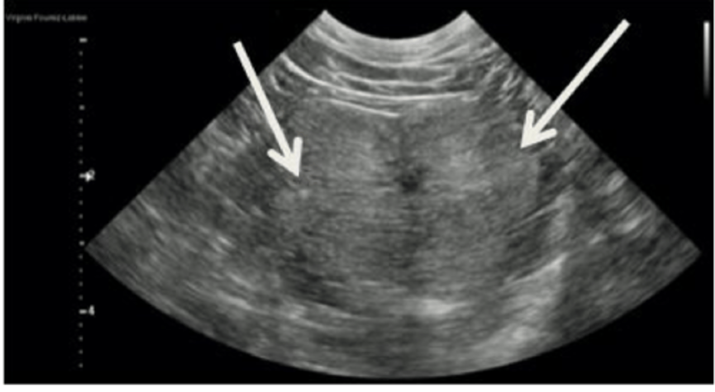 <p>Bilobed with smooth contour</p><p>Homogenous echogenicity</p><p>Central urethra visible</p>