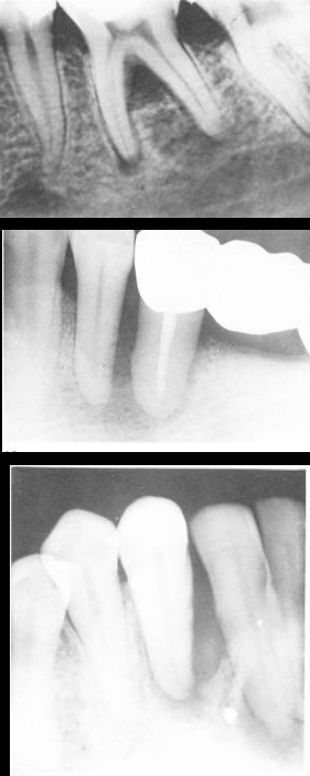 <p>There is a periodontal pocket reaching the apex of the root AND there is absence of pulp vitality, sensitive to percussion and palpation</p><ul><li><p>Could also be bone resorption at apex, spontaneous pain, purulent exudate, mobility, sinus tract</p></li><li><p>an be primarily endo, perio or combined</p></li><li><p>root damage has poor prognosis</p></li><li><p>Always do endo first</p></li></ul><p></p>