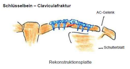 <p>Spezielle Knochen- und Gelenkverletzungen</p><p><strong>Schlüsselbein - Calviculafraktur</strong></p><ul><li><p>umso weiter Knochenenden voneinander entfernt sind desto eher eine Operation</p></li></ul><p></p>