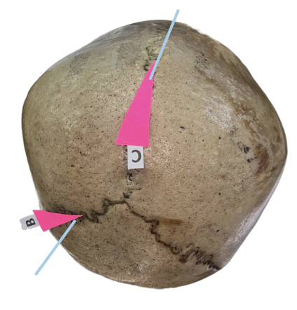 <p>Identify the suture labeled as B.</p>