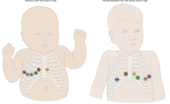 <ul><li><p>Children under two years of age require right-sided placement</p></li><li><p>Children between two and twelve require adapted placement as shown in the next slide</p></li></ul><p></p>