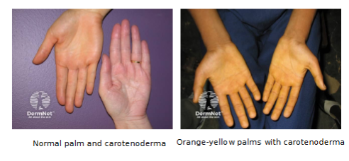 <ul><li><p>yellow to orange pigment found in plant products - e.g.: carrots</p></li><li><p>deposits in keratinocytes (esp. stratum corneum) &amp; hypodermis</p><ul><li><p>carotenoderma: excess carotene</p></li></ul></li><li><p>Most obvious in palms and soles</p></li></ul><p></p>