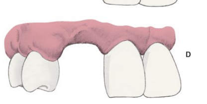 <p>a combination of loss in both dimension (horizontal and vertical loss) </p>