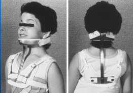 <p>Indications for Guilford brace?</p>