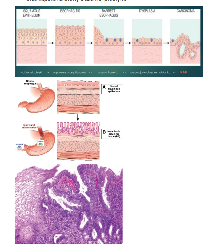 <ul><li><p>patologiczny stan polegający na obecności w dolnej części przełyku <strong>ognisk metaplazji jelitowej</strong> zamiast nabłonka wielowarstwowego płaskiego (prawidłowego dla przełyku) → zastąpienie nabłonka wielowarstwowego płaskiego, nabłonkiem walcowatym charakterystycznym już dla żołądka</p><ul><li><p>obecne są <strong>komórki gruczołowe</strong> z komórkami kubkowymi</p></li><li><p>dochodzi do przemieszczenia granicy pomiędzy nabłonkami (tzw. linia Z) w okolicy połączenia przełyku z żołądkiem</p></li></ul></li><li><p>stan przedrakowy/zmiana przednowotworowa → zwiększa ryzyko wystąpienia raka przełyku i wymaga częstszej kontroli endoskopowej</p></li><li><p>przyczyny:</p><ul><li><p>możliwe powikłanie ChRP (przewlekłe zarzucanie treści żołądkowej) oraz zapalenia błony śluzowej przełyku</p></li></ul><p></p><p></p><p></p></li></ul><p></p>